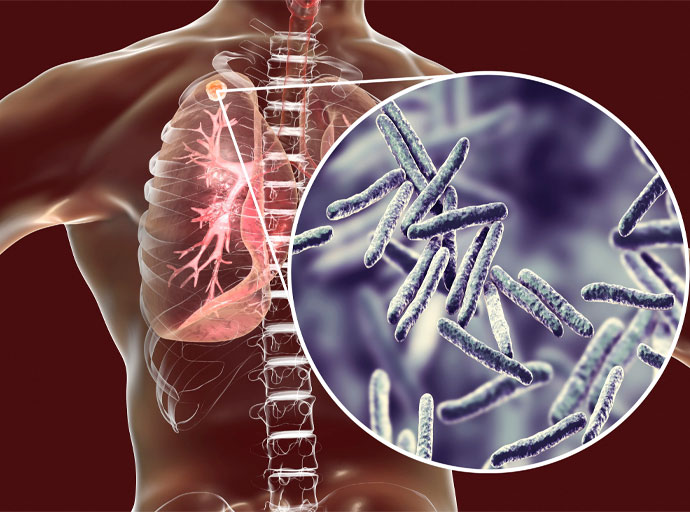 ලෝක ක්ෂය රෝග දිනය; සෞඛ්‍ය නියෝජ්‍ය අමාත්‍යවරයා ඇතුළු නිලධාරීන්ට විශේෂ පලඳනාවක්